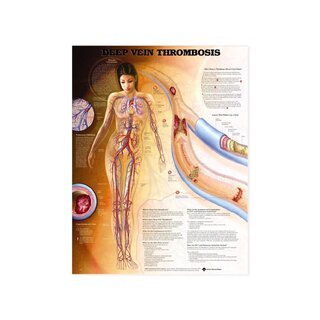Hluboká žilní trombóza (DVT) - plakát