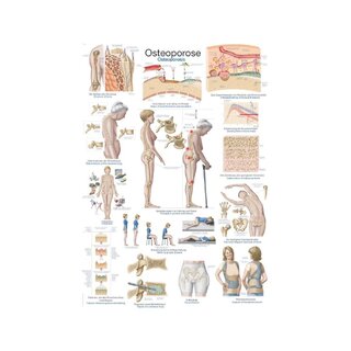 Plakát Osteoporóza, Anatomický plakát 50x70cm